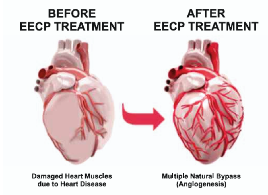 Before and After Chelation Therapy