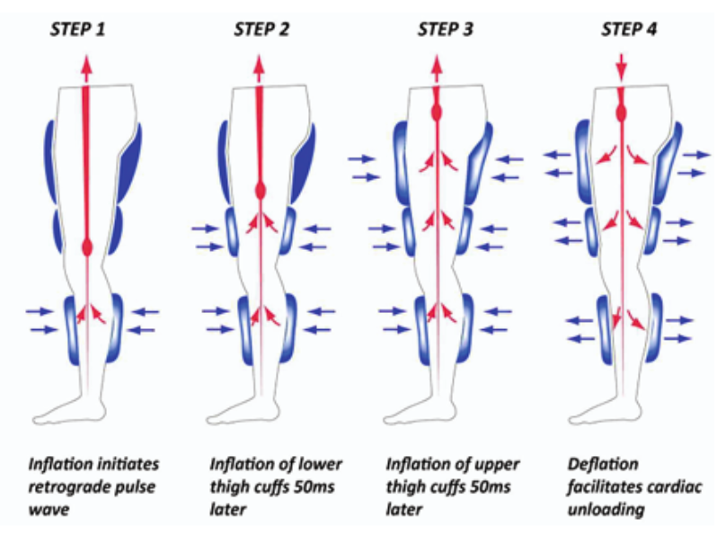 How EECP Works - 4 Step Process